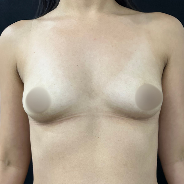 Foto antes da mamoplastia de aumento