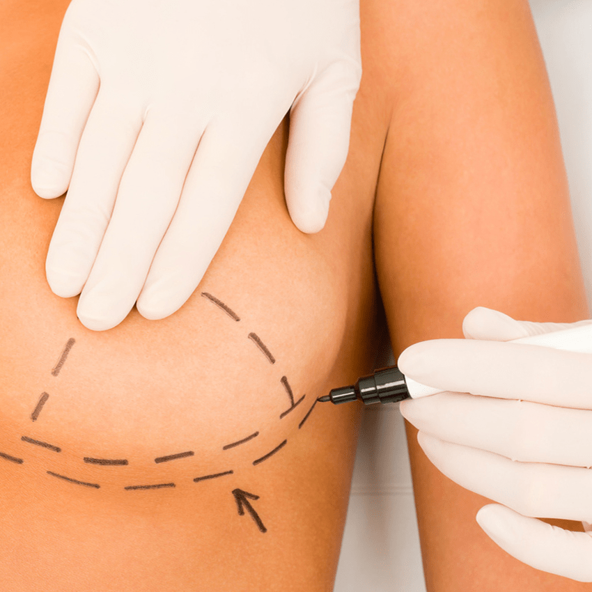 Ilustração clínica de mamoplastia redutora